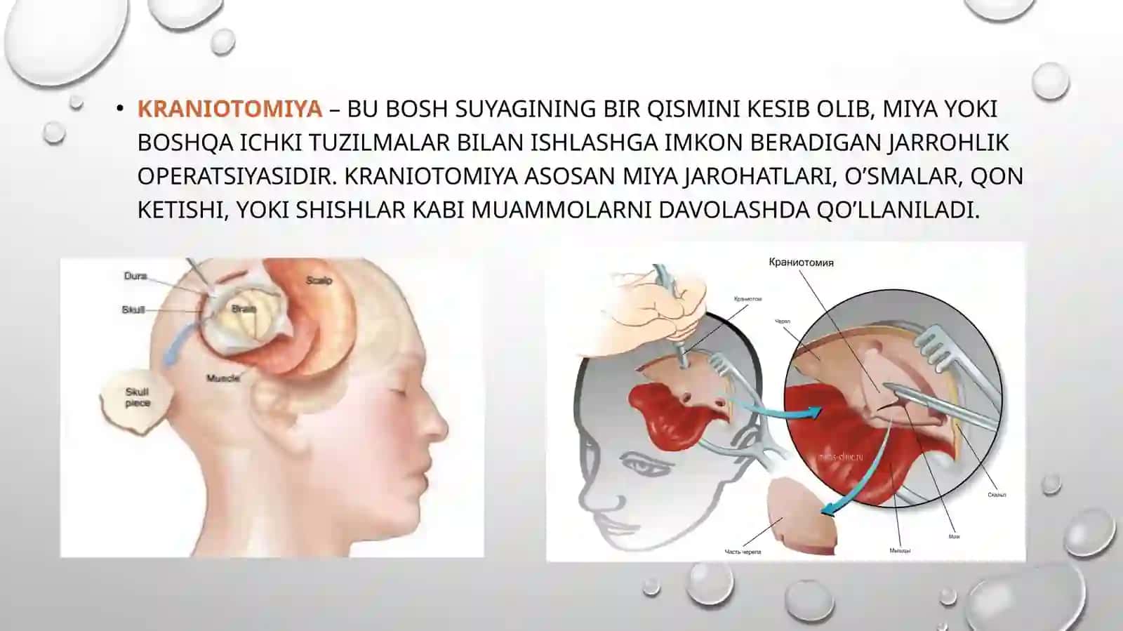 Kraniotomiyavakranioplastika 2