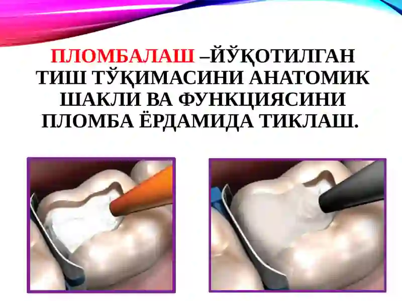 Пломба ашёларининг таснифи 2