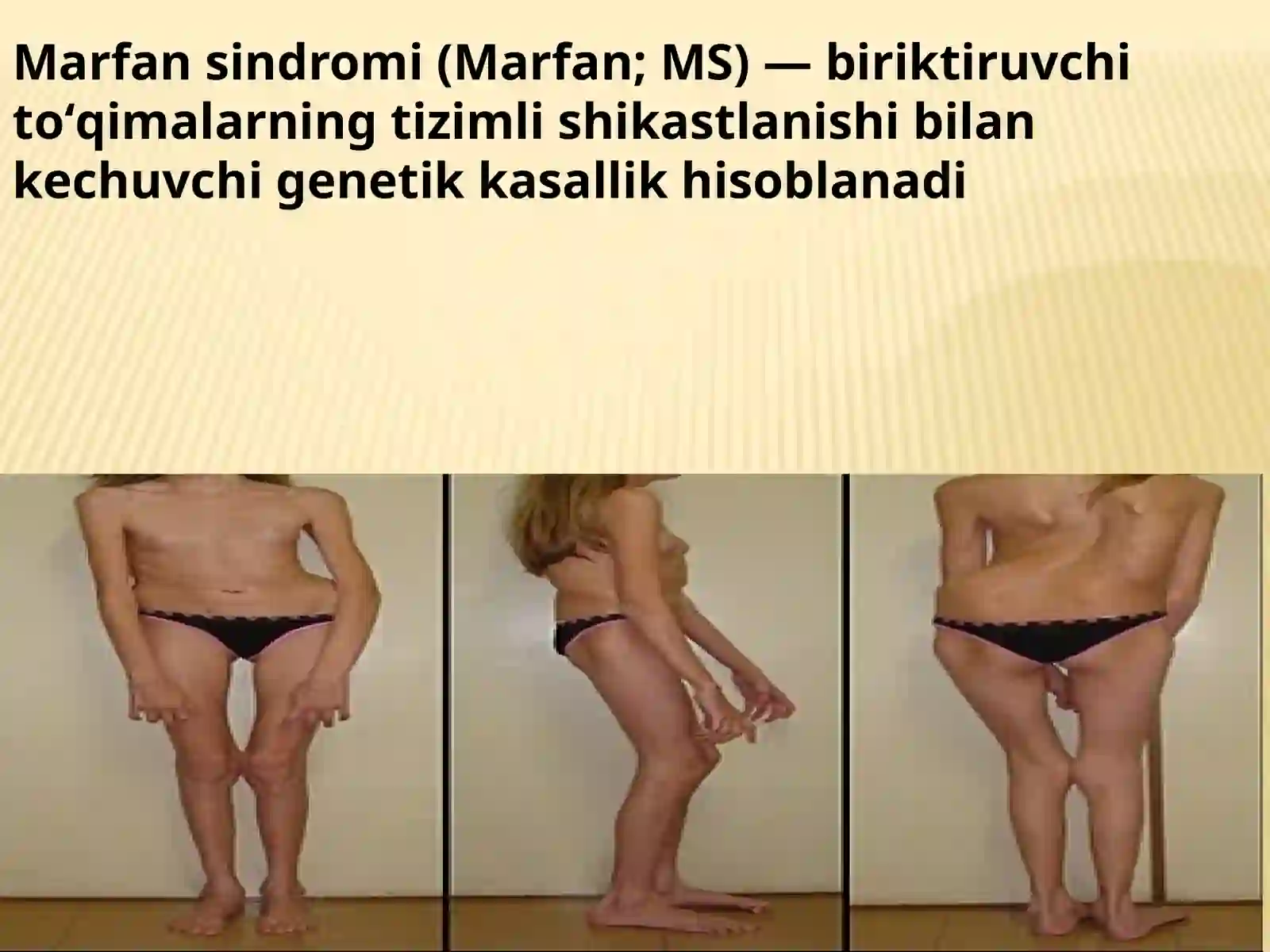 Marfan sindromi 2