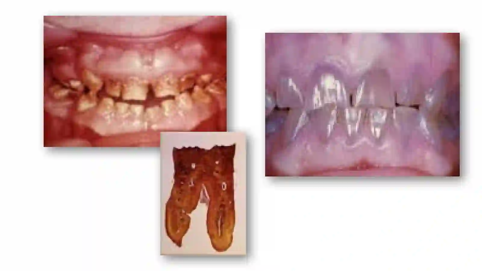 Tugallanmagan Dentinogenez 2