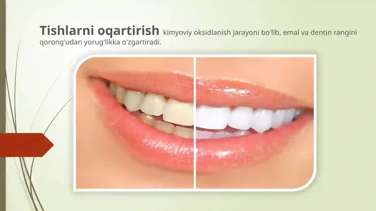 Tishlarni oqartirish uslubi.O’tkazish texnikasi 2