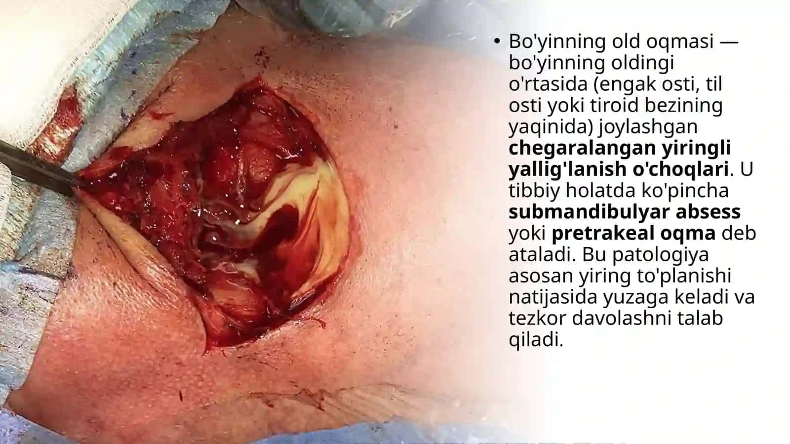 Boyinning old oqmasida (absses) bajariladigan jarrohlik amaliyoti 2