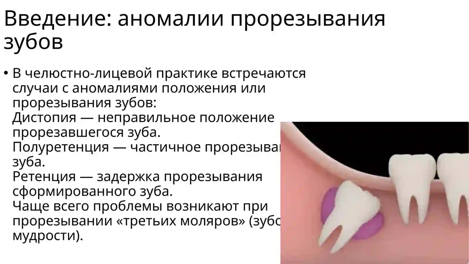 Болезни прорезывания зубов: перикоронит, ретромолярный периостит 2