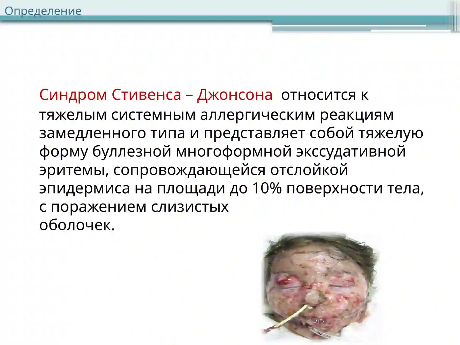СИНДРОМСТИВЕНсА-ДЖОНСонА 2