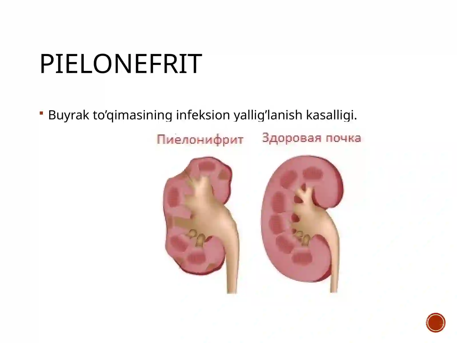 Siydik yo’llari yallig’lanish kasalliklari. Pielonefrit, sistit 2