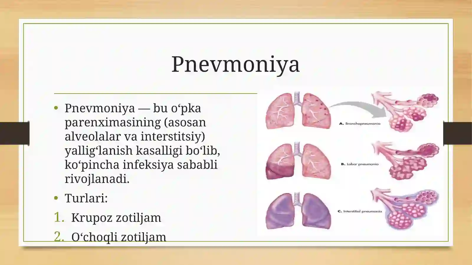 Pnevmoniya 2