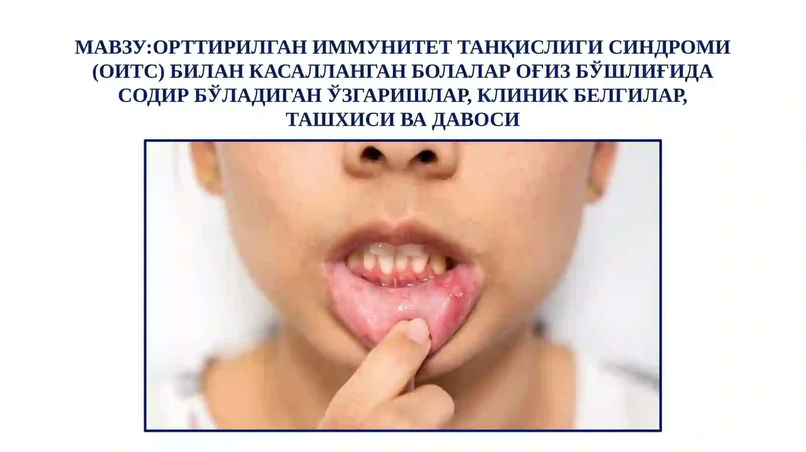 Орттирилган иммунитет танқислиги синдроми (ОИТС) билан касалланган болалар оғиз бўшлиғида содир бўладиган ўзгаришлар 2