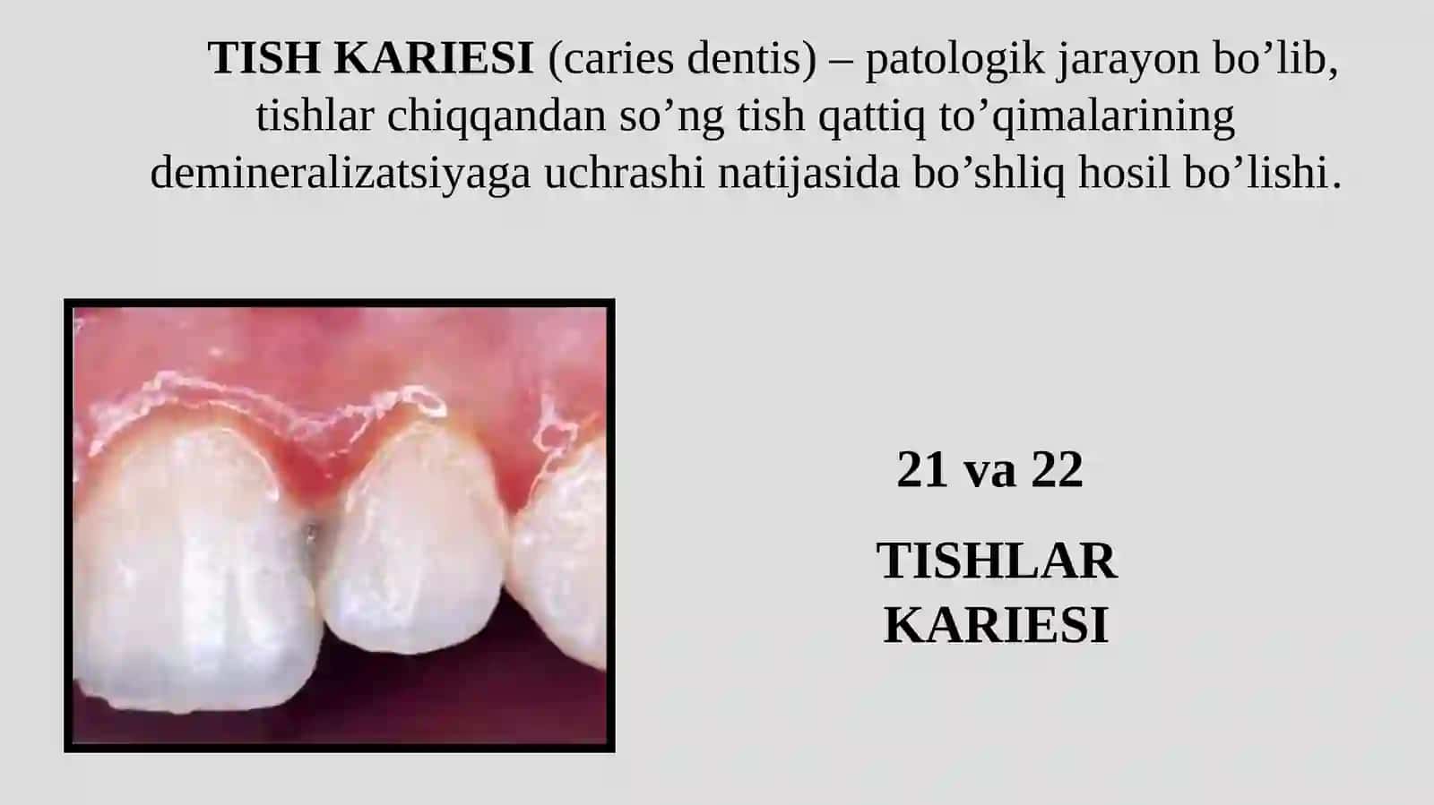 Tishlar Kariesi 2