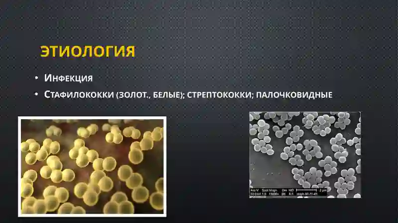 Одонтогенный остеомиелит челюсти 2