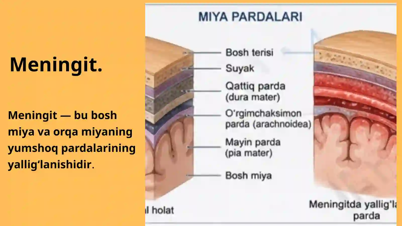 Meningit 2