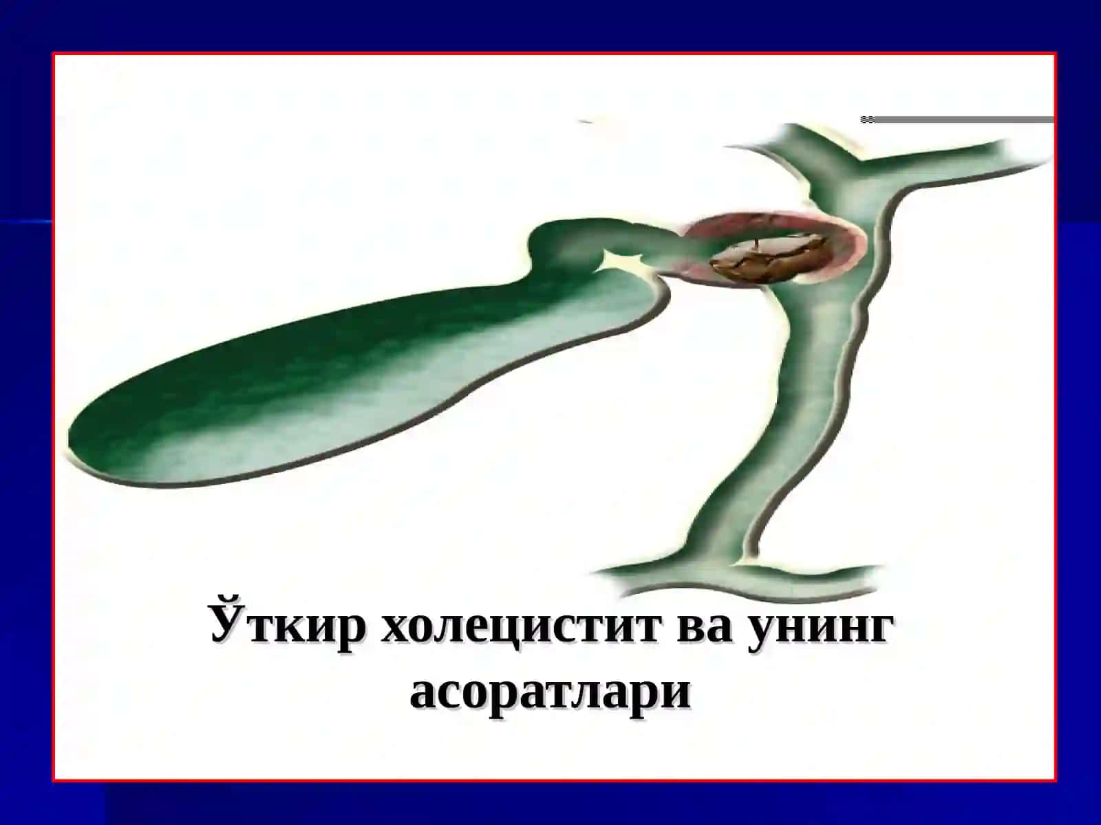 Ўткир холецистит ва унинг асоратлари 2