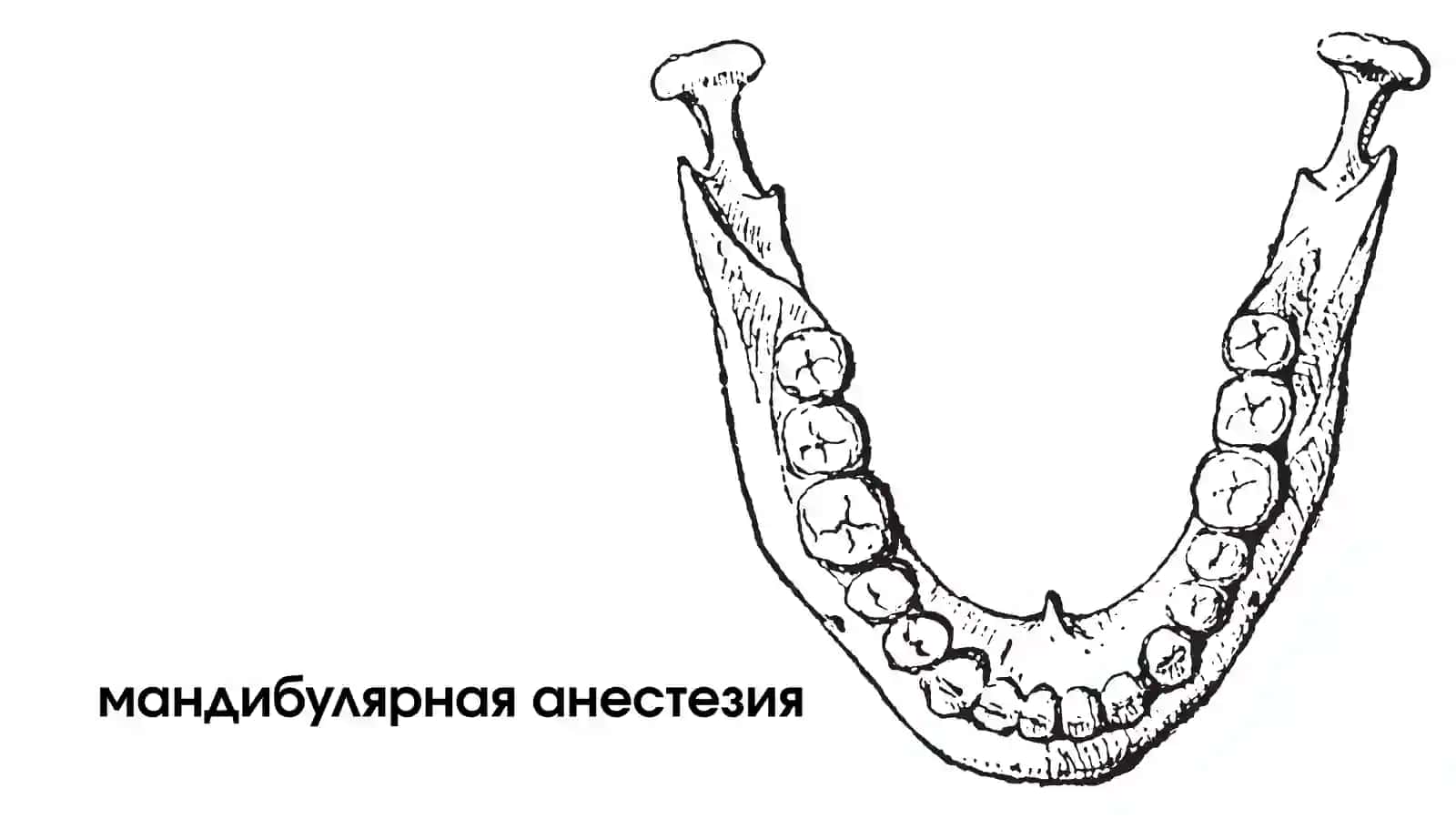 Мандибулярная анестезия 2