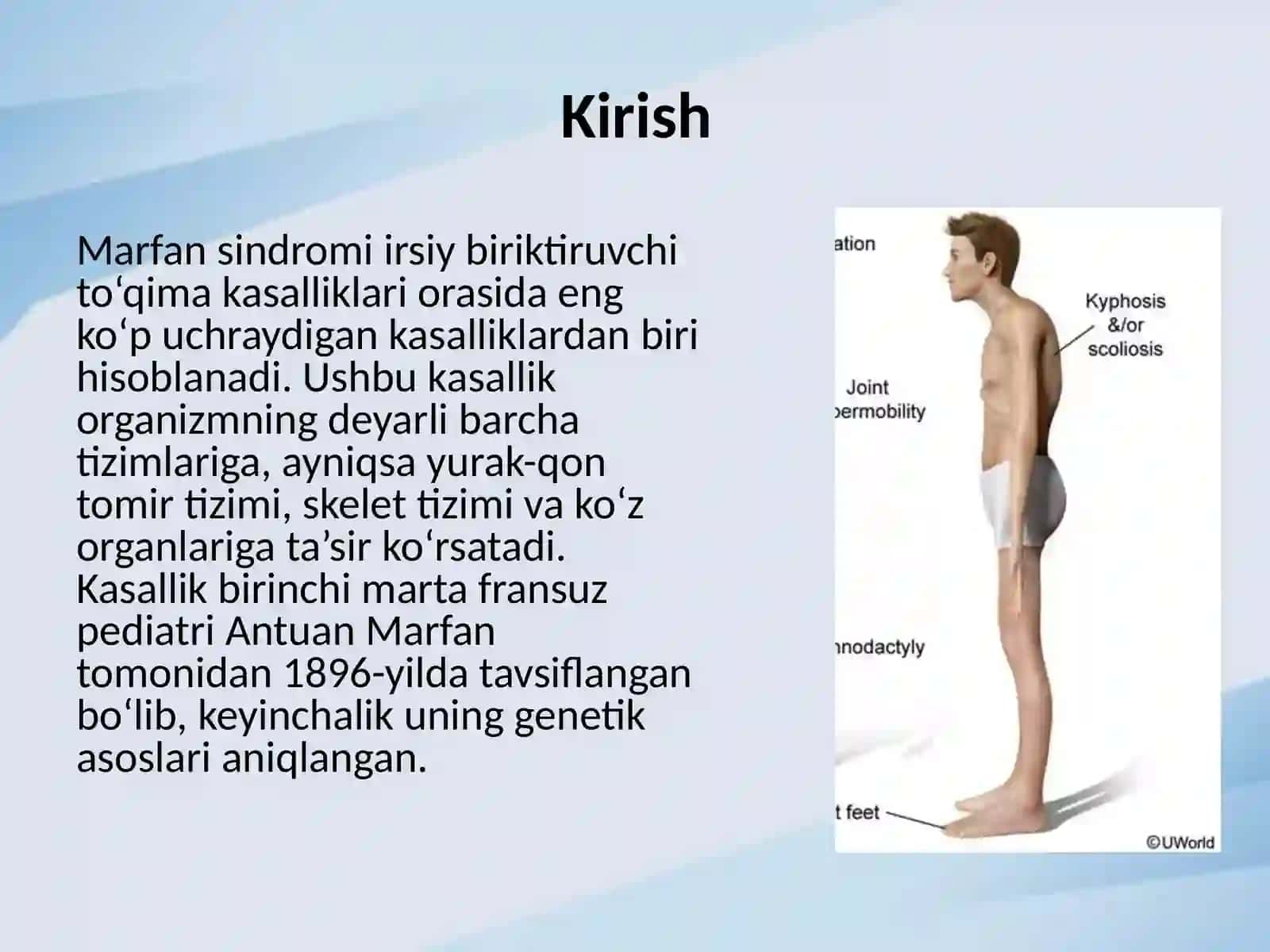 Marfan sindromi 2