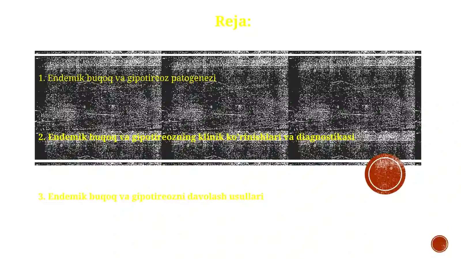 Endemik buqoq va gipotreoz patogenezi va davolash usullari 2