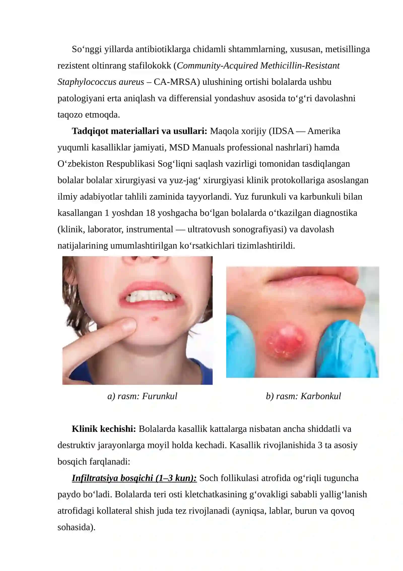 BOLALARDA YUZ SOHASI FURUNKUL VA KARBUNKULLARINING KLINIK KECHISHI, ERTA TASHXISLASH, DAVOLASHDA KOMPLEKS VA DIFFERENSIALLASHGAN YONDASHUV 2