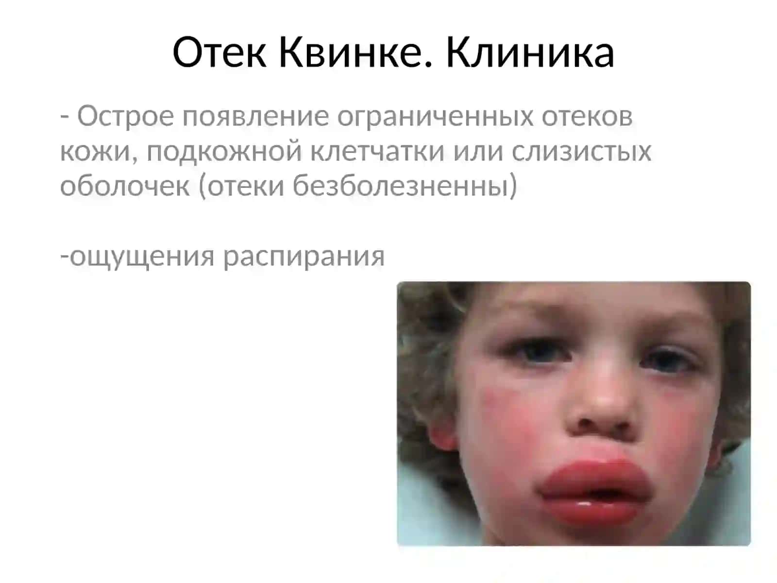 ОтекКвинке. Крапивница.Неотложная помощь 2