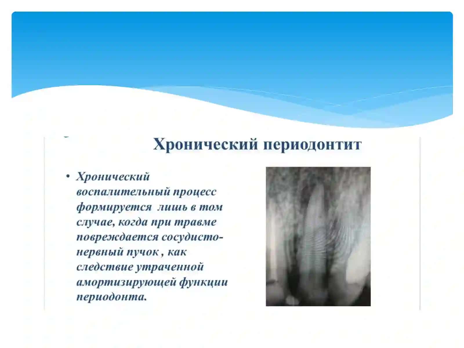 Хронические формы периодонтитов классификация клиника,диагностика 2