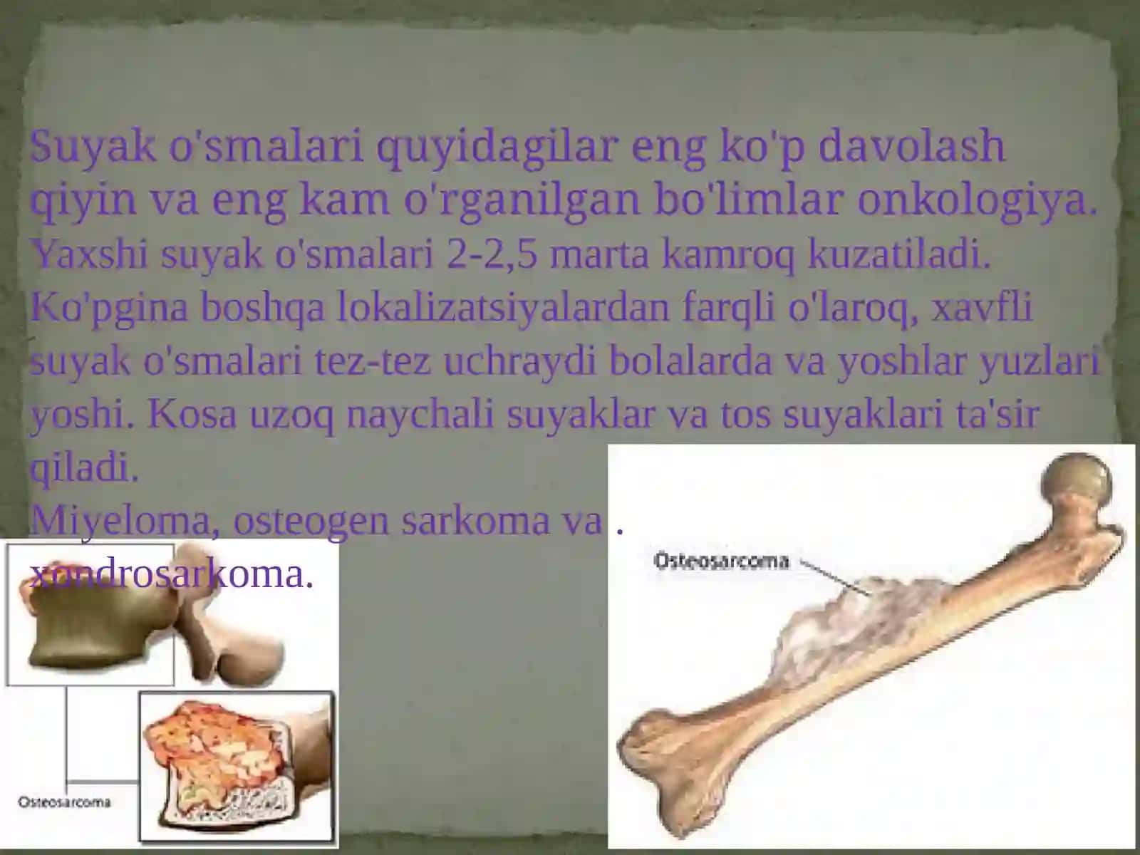 Harakat-tayanch tizimida og'riqli sindromi. Harakat-tayanch tizimida o'smalari 2