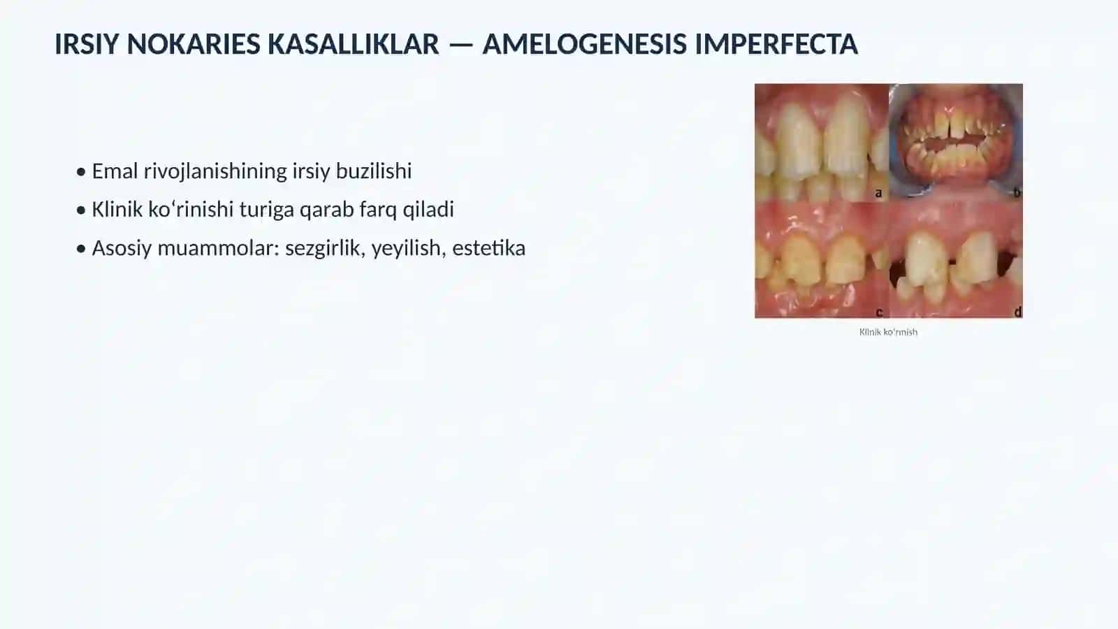 IRSIY NOKARIES KASALLIKLAR — AMELOGENESIS IMPERFECTA 2