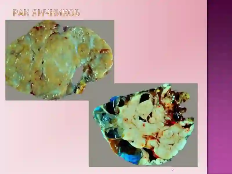 Рак яичников 2