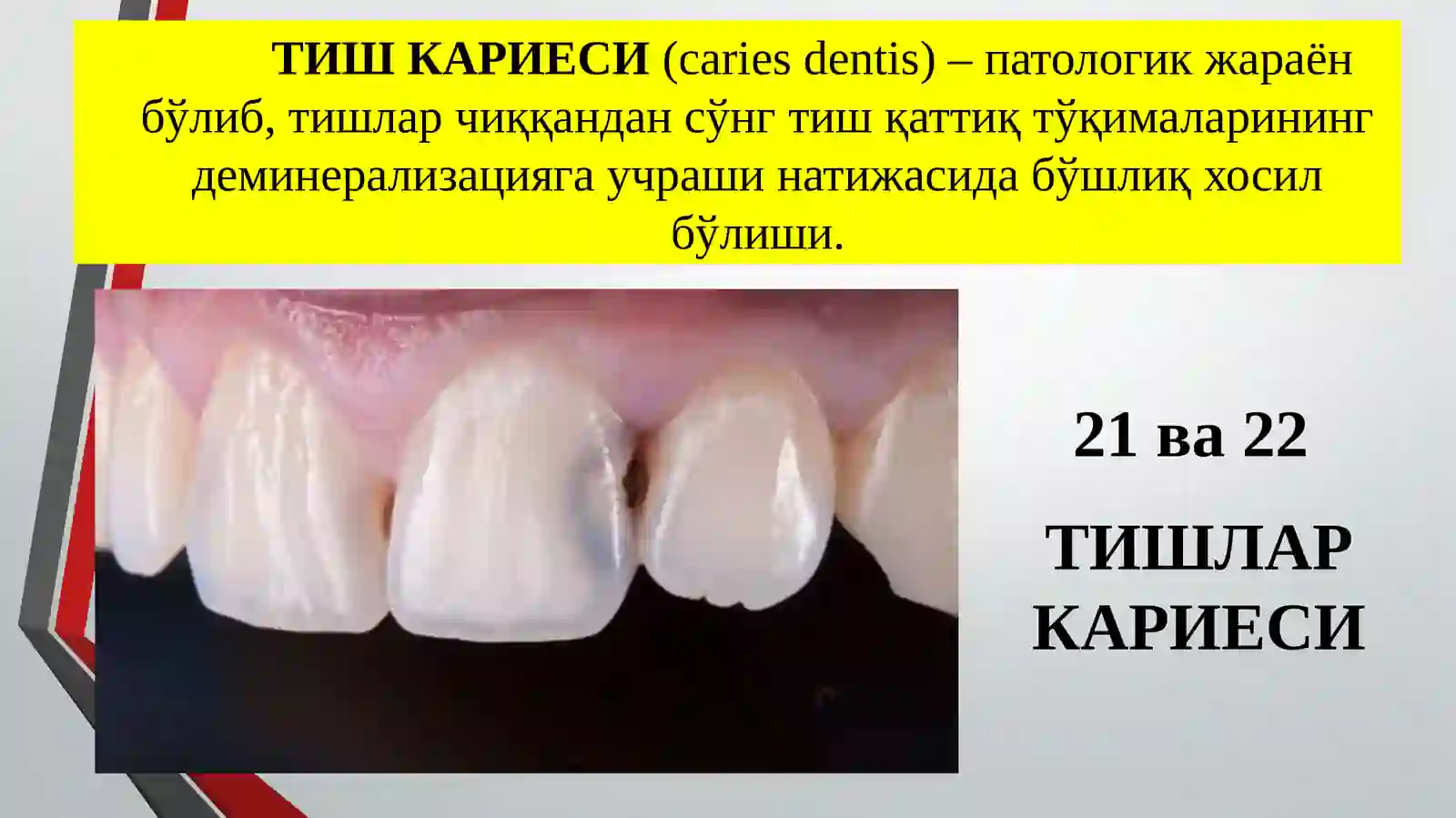 ТИШЛАР КАРИЕСИ 2