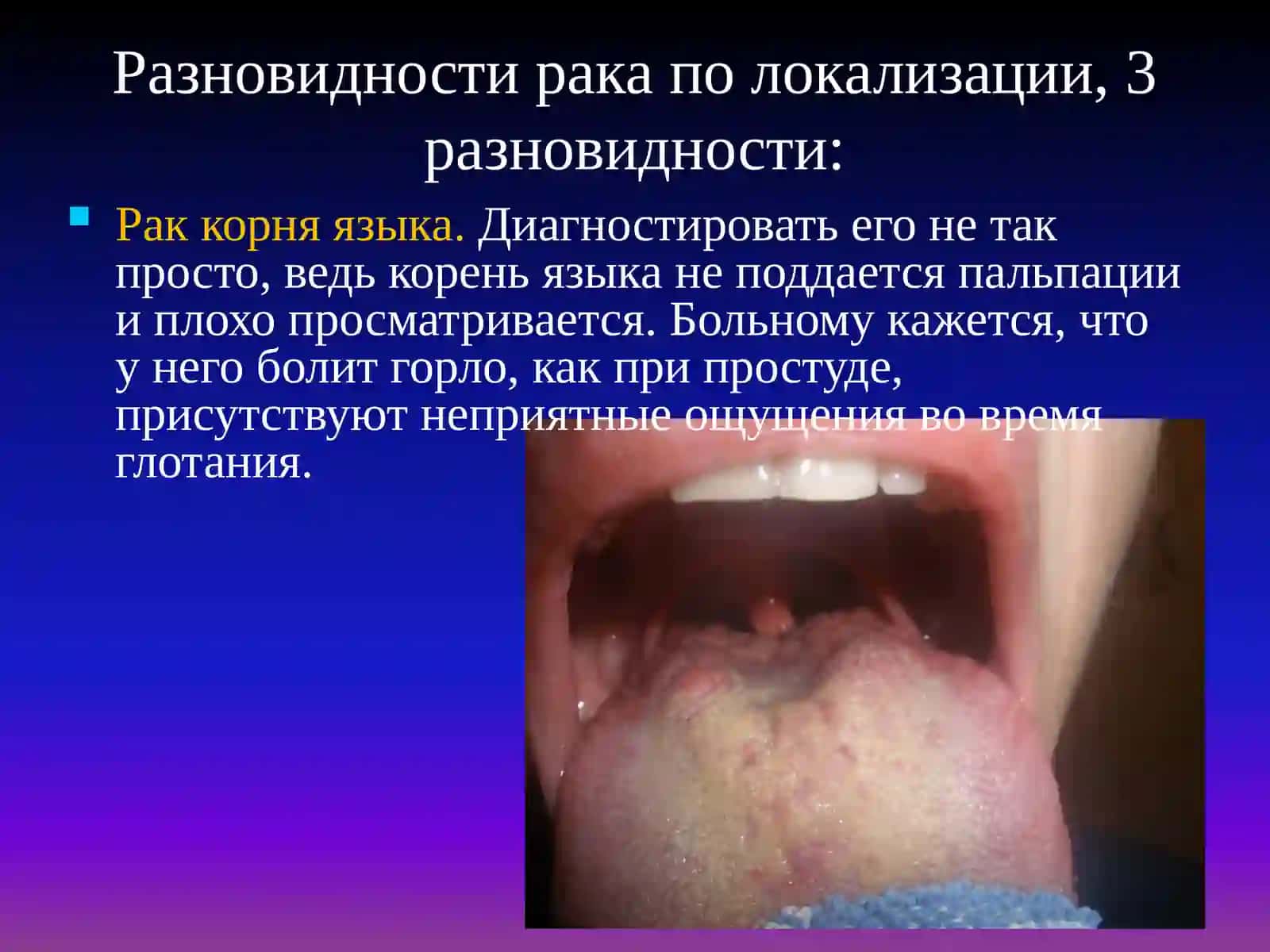 Рак корня языка 2