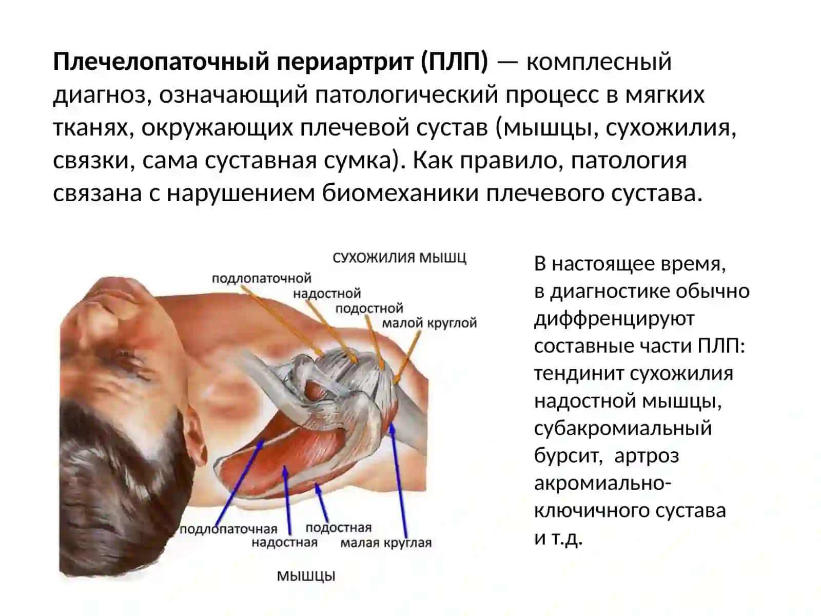 Плечелопаточный периартрит 2