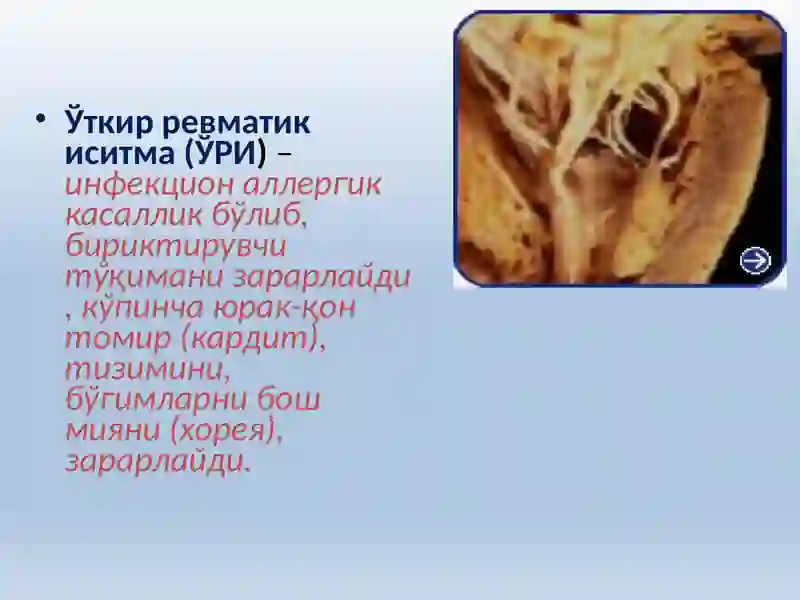 Ўткир ревматик иситма. 2