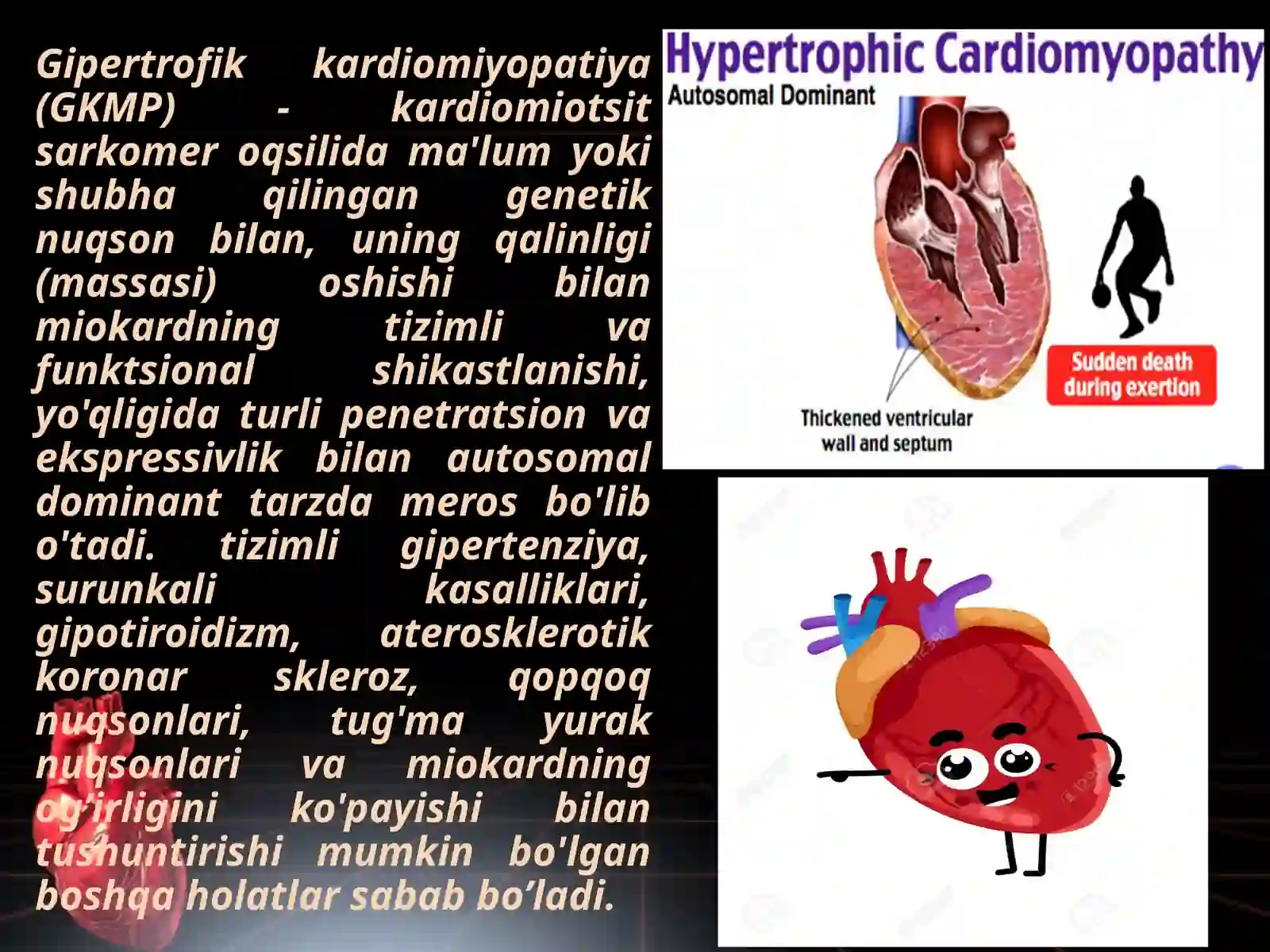 Gipertrofik kardiomiyopatiya 2