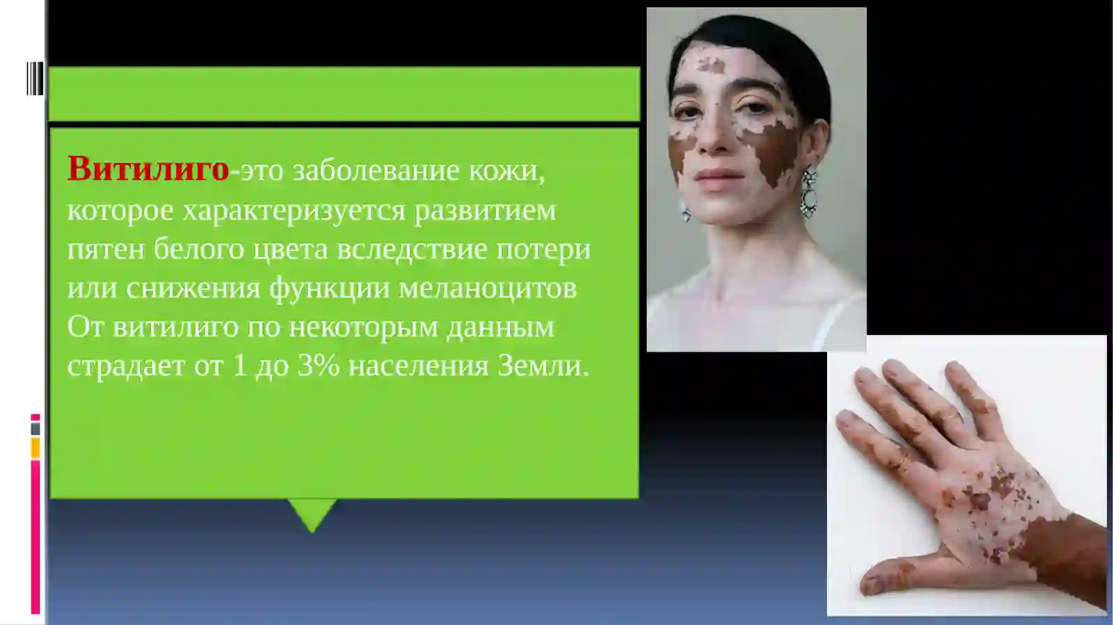 Витилиго 2
