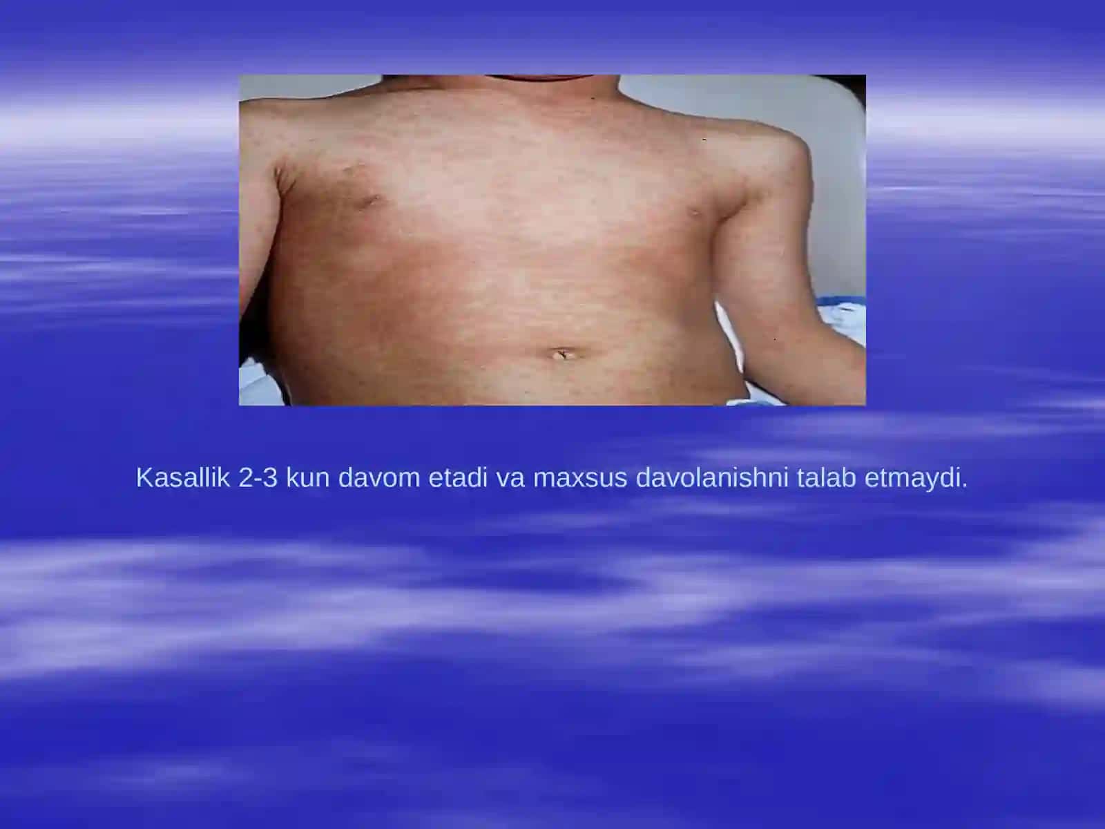 Qizamiq kasalligi va diagnostikasi 2