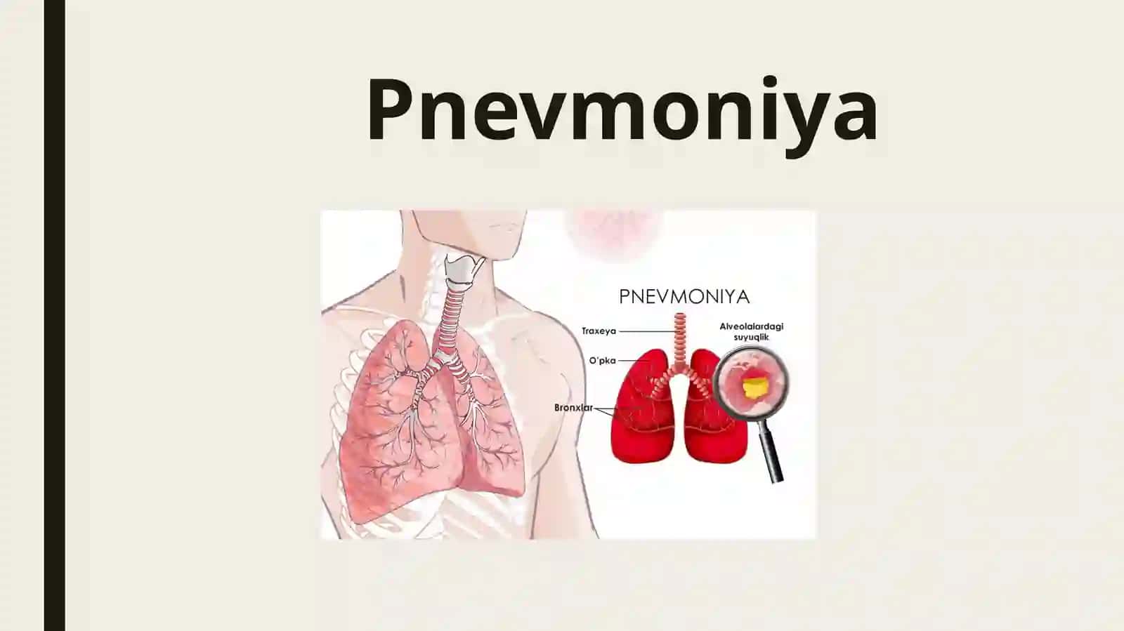 PneVmoniya 2