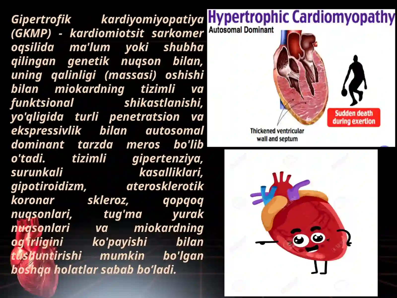 Gipertrofik kardiyomiyopatiya 2