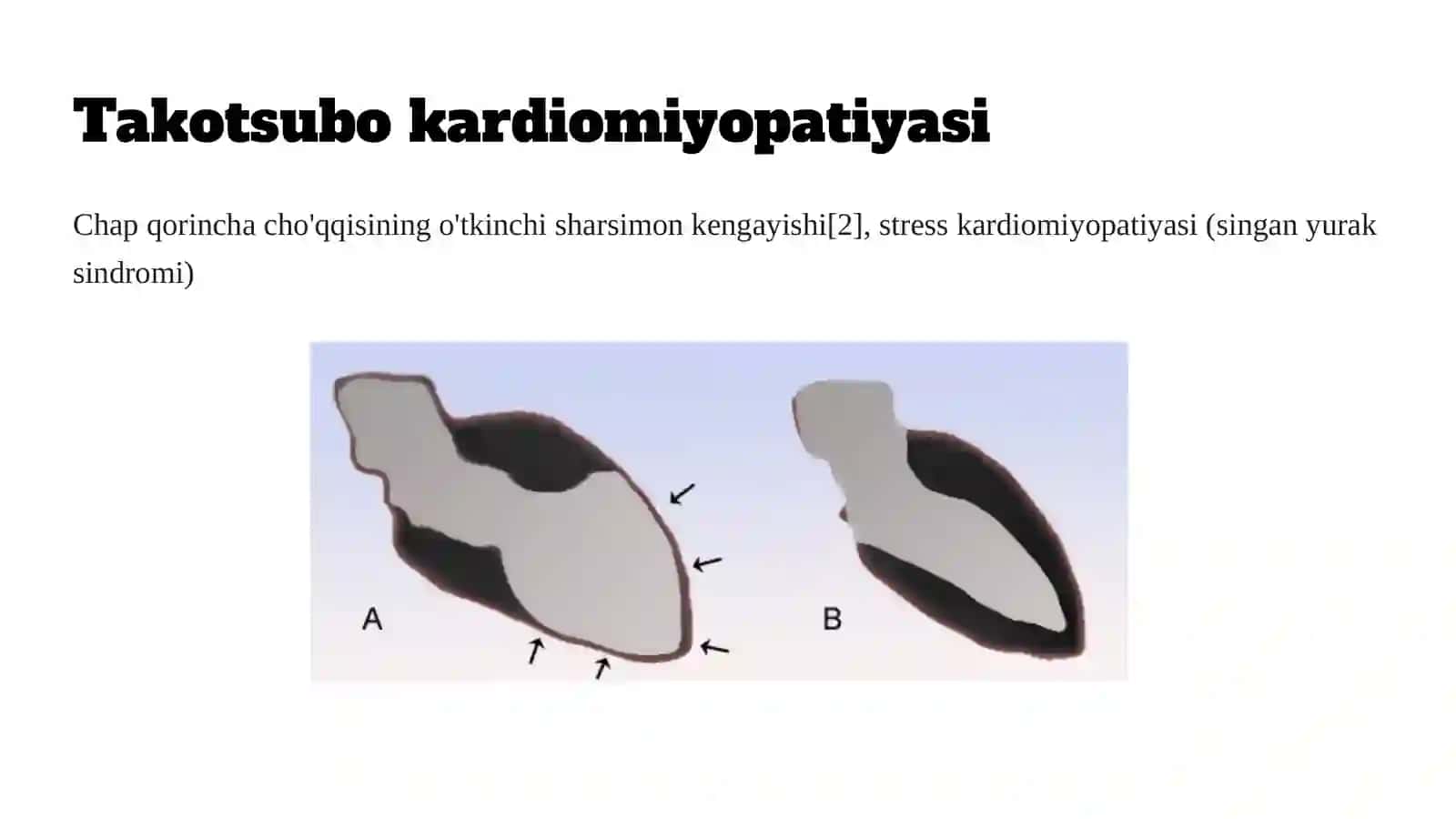 Takotsubo kardiomiopatiyasi (1-variant) 2