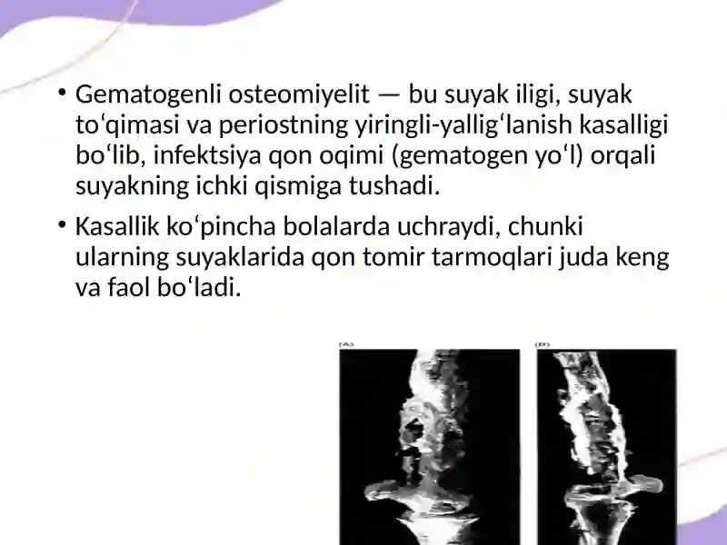 Gematogenli osteomiyelit 2