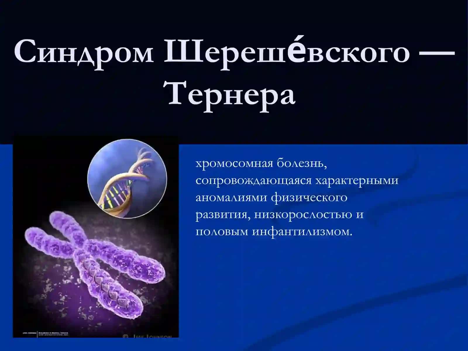 Синдром Шерешевского - Тернера 2