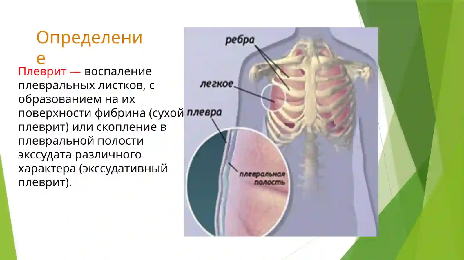 Плеврит 2