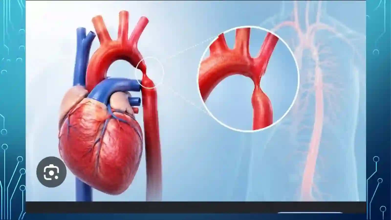 Aortakoarktatsiyasi 2