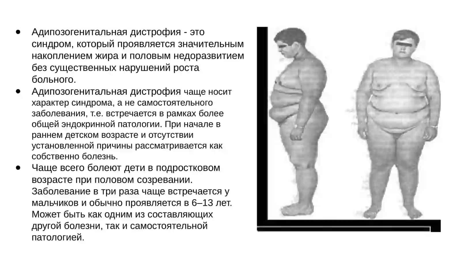 Адипозогенитальная дистрофия (Болезнь Фрелиха) 2