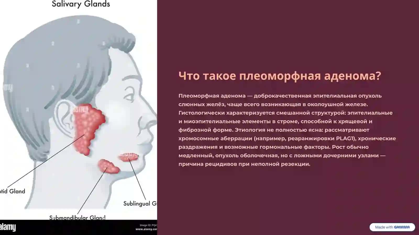 Плеоморфная аденома: Клинический обзор и лечение 2