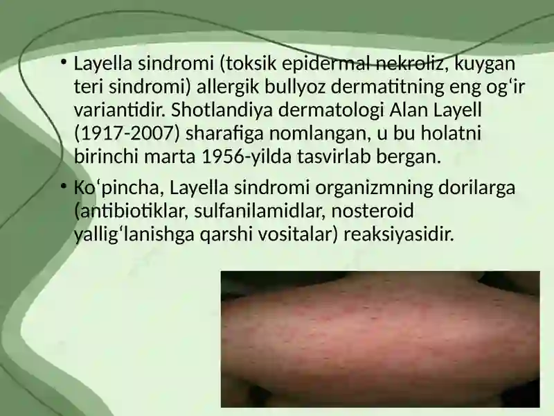 Layell va Stiven Djonson sindromlari 2