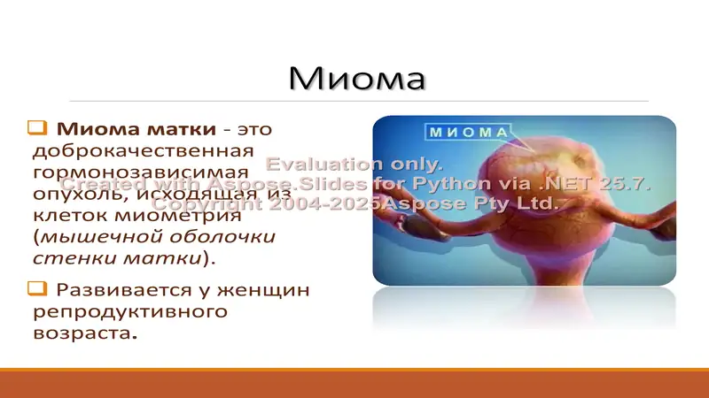 Миома матки 2