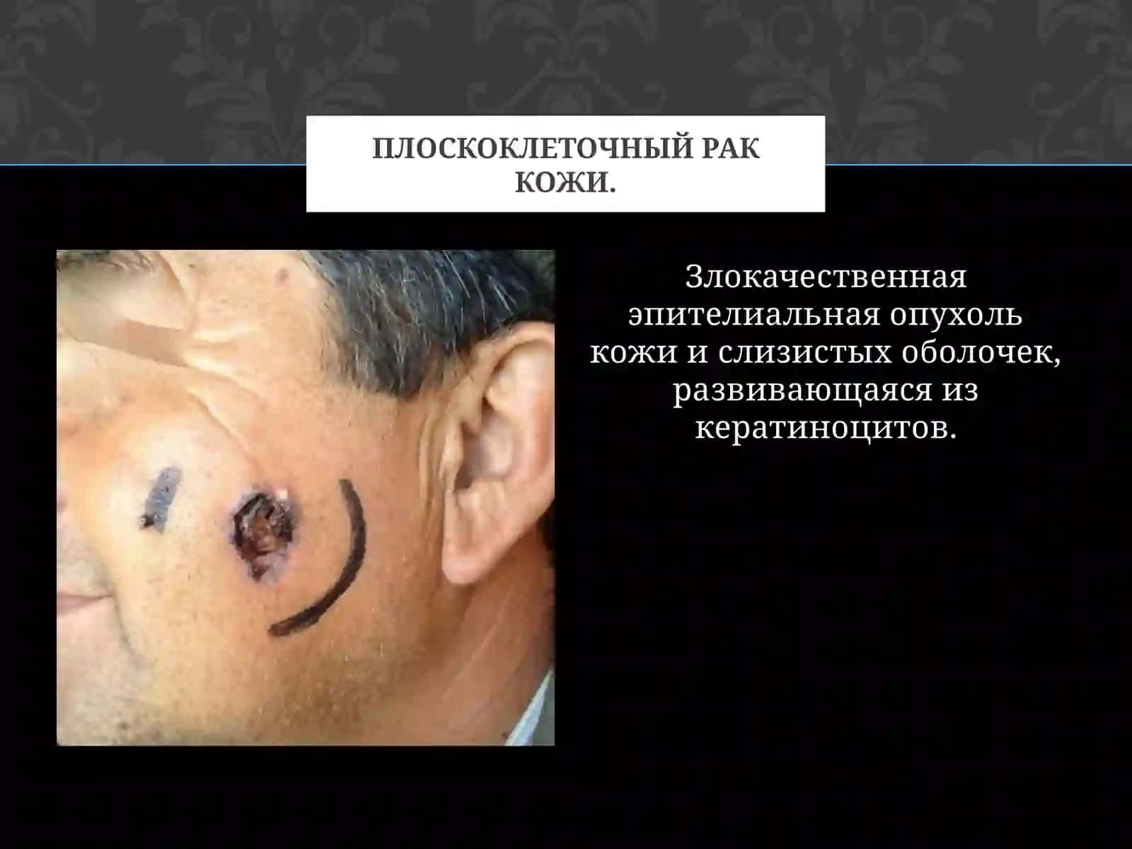 Плоскоклеточный рак кожи 2