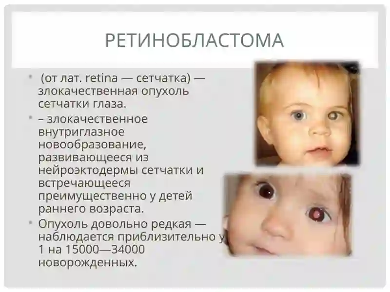Ретинобластома 2