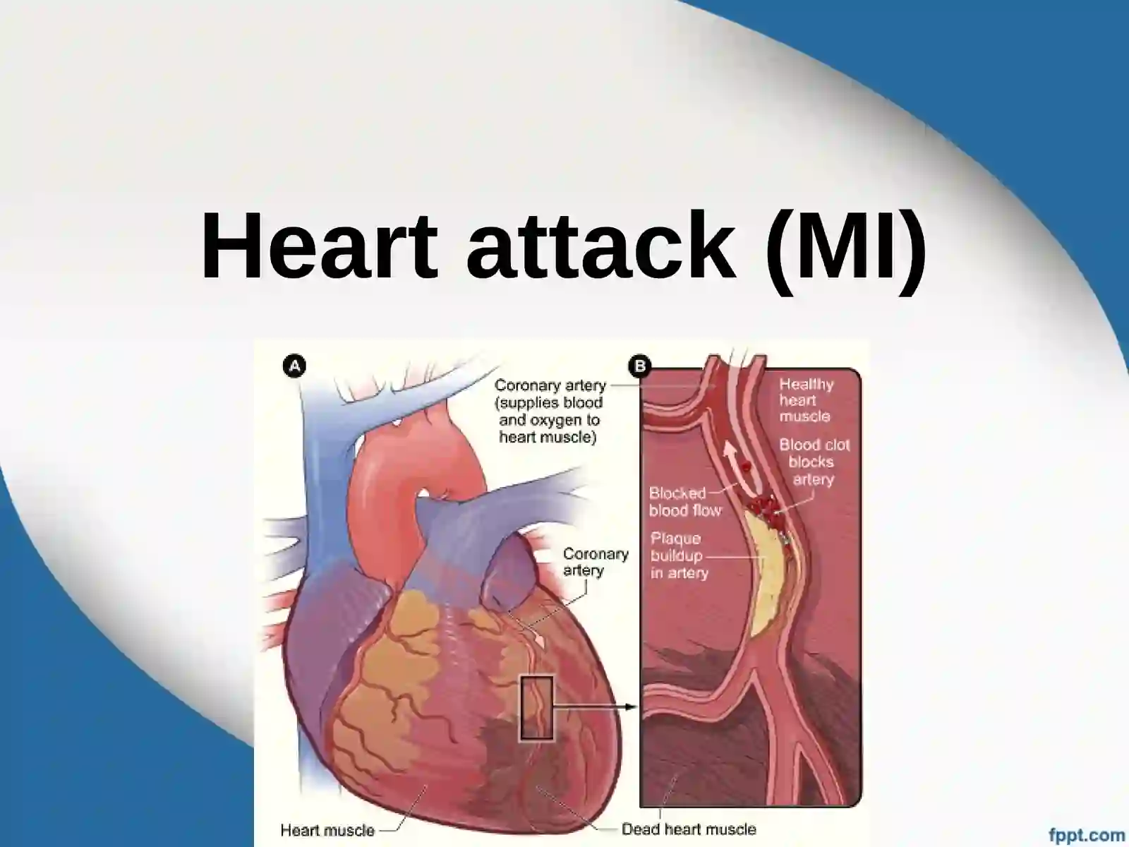 Heart attack (MI) 2