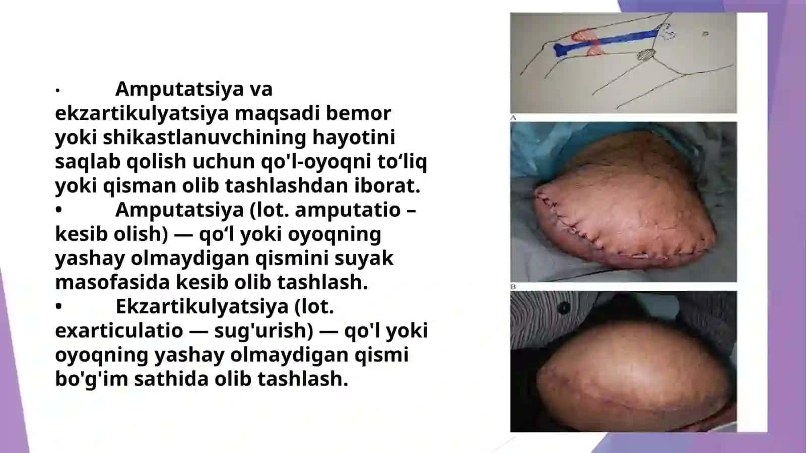 Qo‘l va oyoq amputatsiyalari va ekzartikulatsiyalari. Qo‘l va oyoq suyaklaridagi operatsiyalar 2