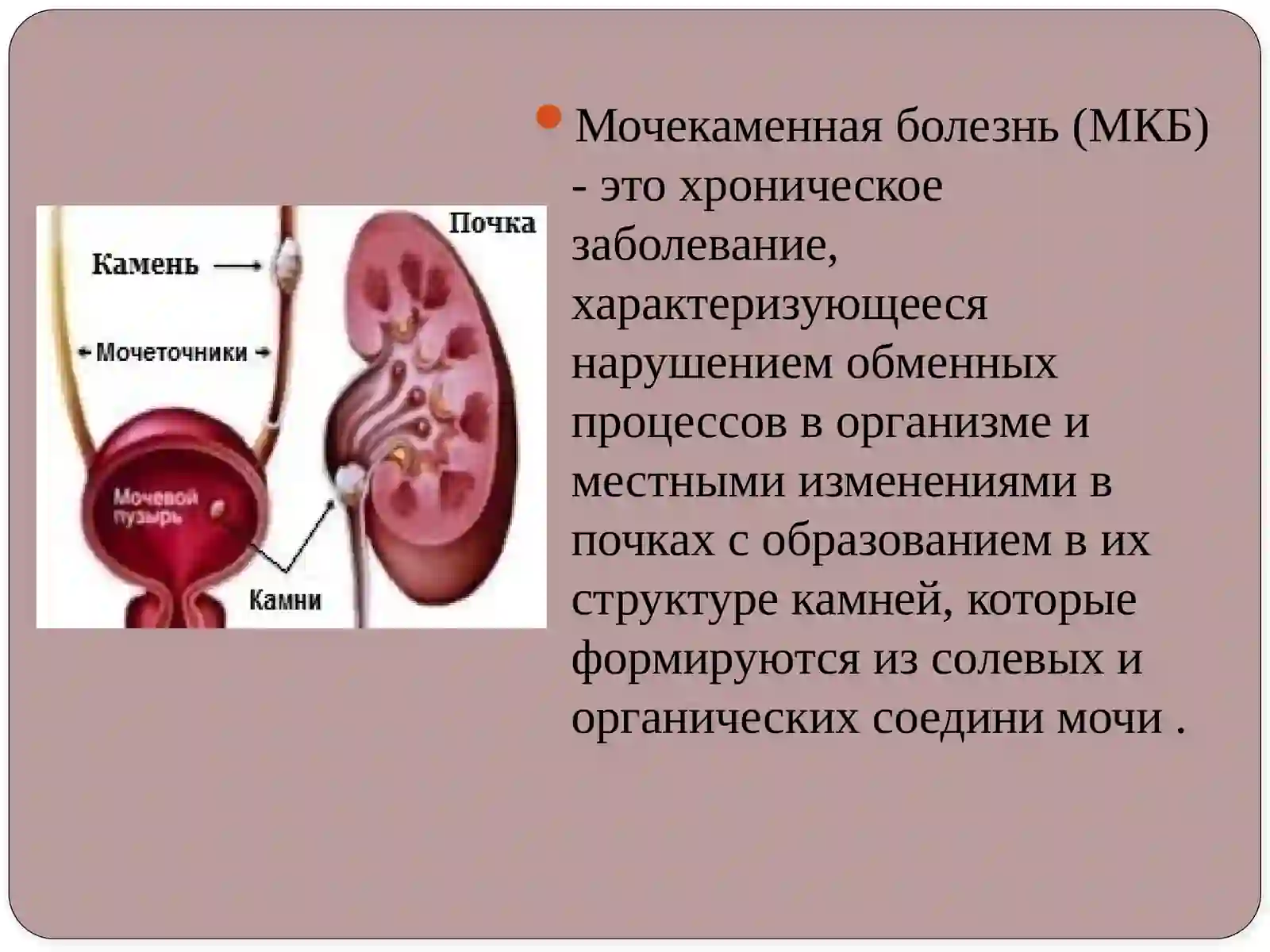 Мочекаменная болезнь 2