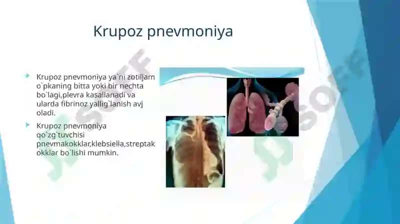 Krupoz pnevmoniya 2