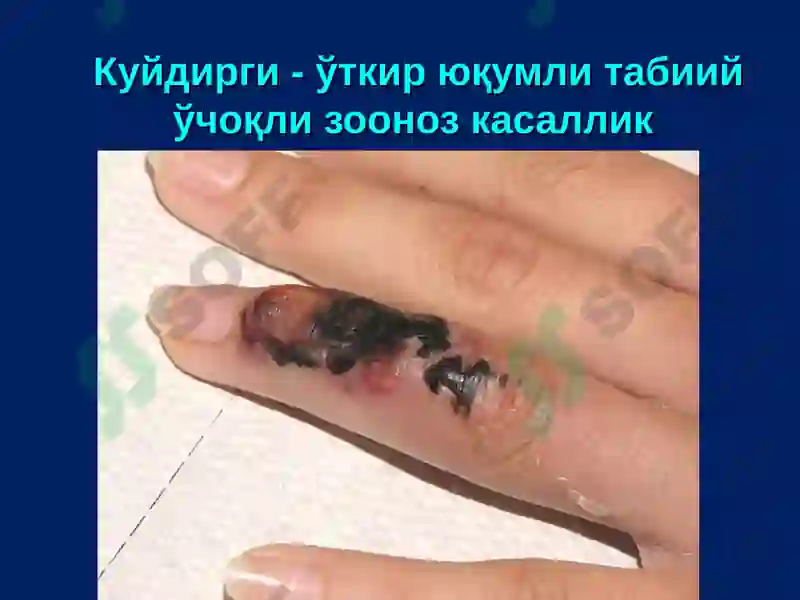 Куйдирги (Bacillus anthracis) 2