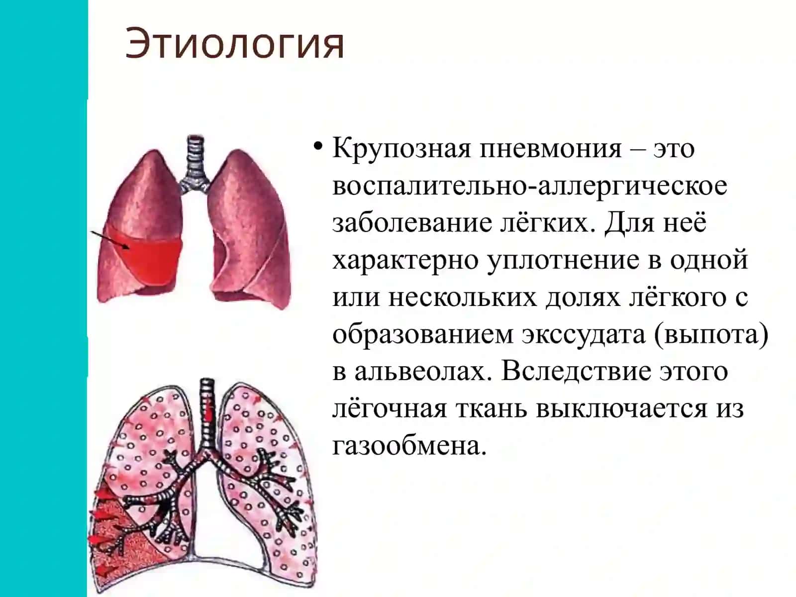 Крупозная пневмония 2